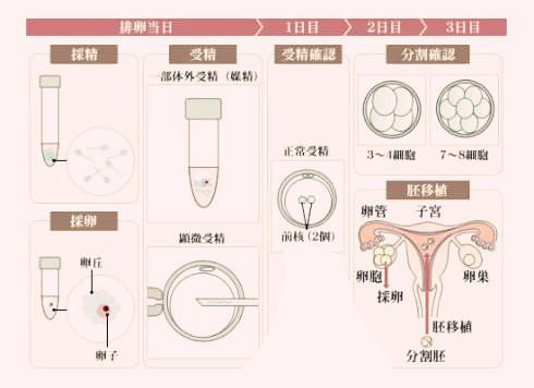 台湾试管婴儿技术之取卵流程—医羽自助