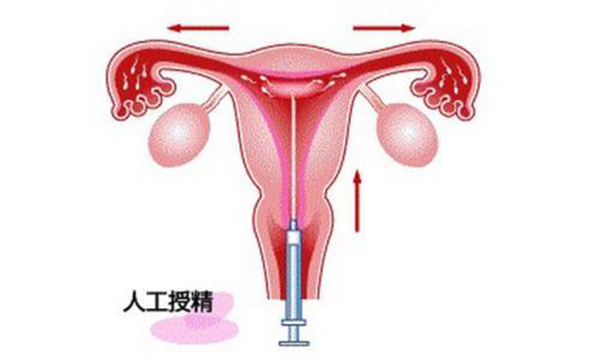 什么是人工授精（IUI）？哪些不孕不育人群需要做人工授精？