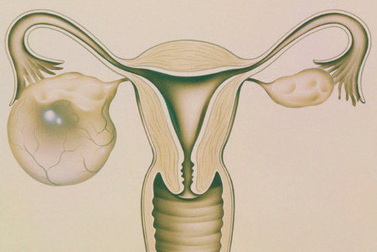 卵巢囊肿会影响试管婴儿成功率吗？