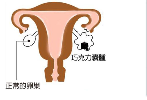 巧克力囊肿如何做才能生育健康的宝宝呢？