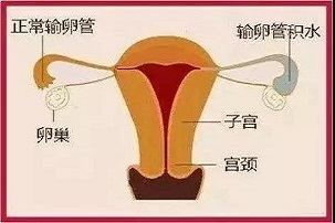 哪类妇科疾病不治疗，会成为试管手术失败的“元凶”？