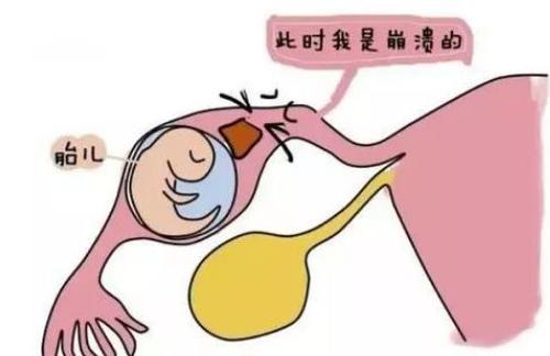 2次宫外孕输卵管切除做试管还会宫外孕吗？