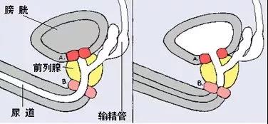 科普|什么是逆行射精？精子都跑哪里去了？