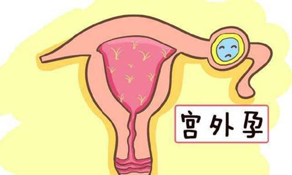 你真的了解宫外孕吗？试管婴儿可以降低宫外孕几率吗？